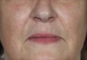 Mezoterapia twarzy, szyi i dekoltu Łodź fot.13